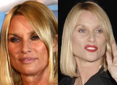 Zoufal manelka Nicollette Sheridan ped a po aplikaci botoxu